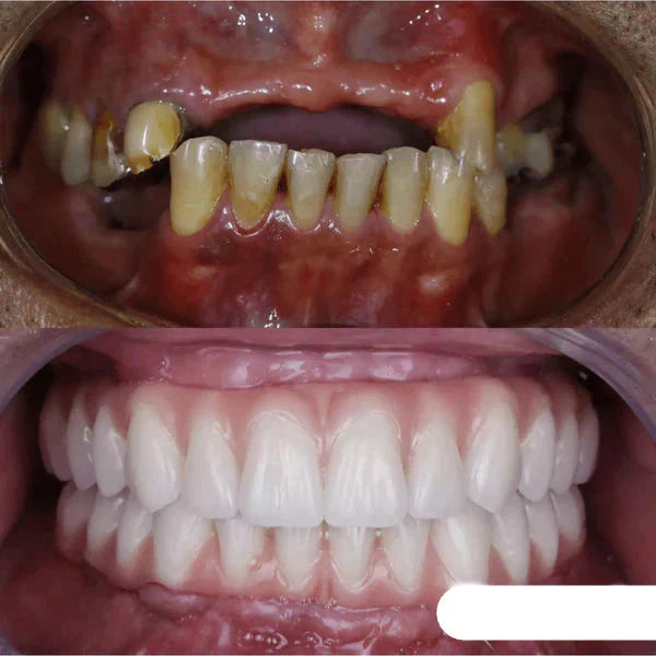 Dentadura de Silicone FIX | Ajustavel e Adaptativa