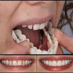 Lente de Contato Dental Removível Inferior e Superior